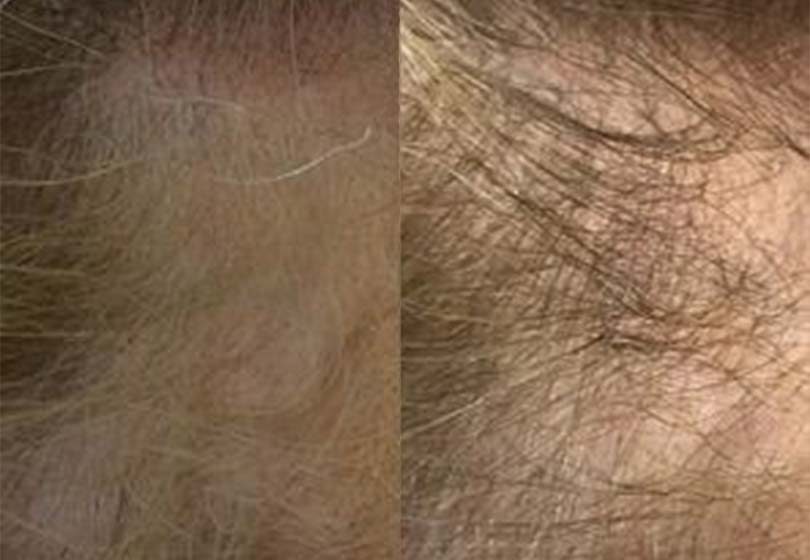 PRP-Hair-Restoration1