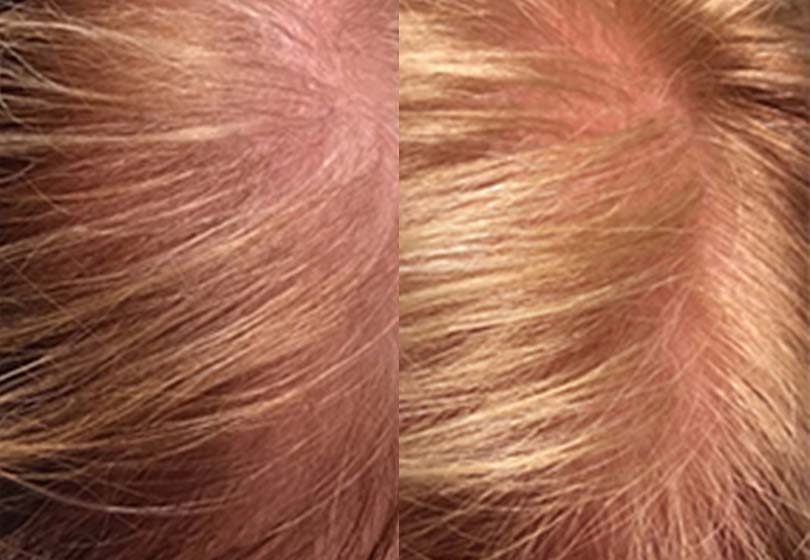 PRP-Hair-Restoration2