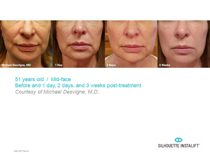 Immediately lifting sagging, aging skin in the mid-face area