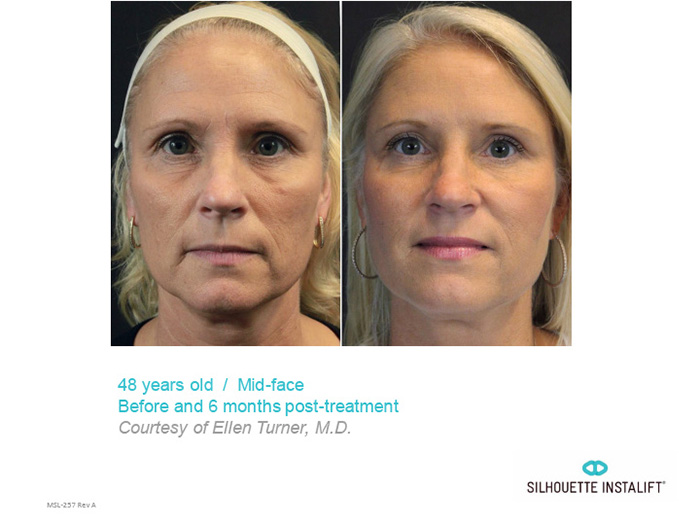 Immediately lifting sagging, aging skin in the mid-face area