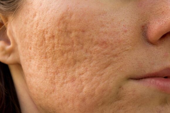 Treating Acne Scars: How Long Does It Take?
