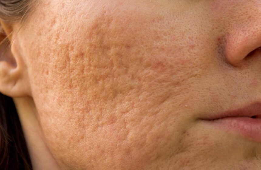 Treating Acne Scars: How Long Does It Take?