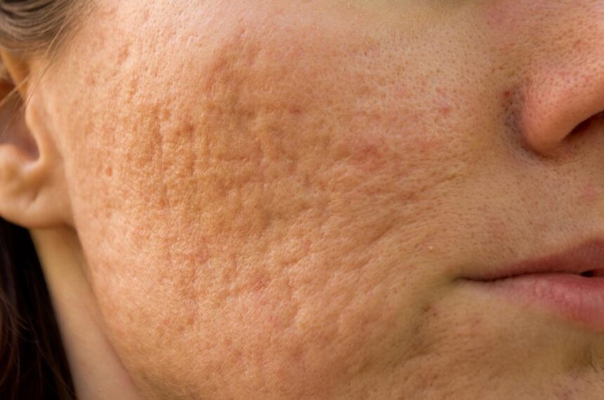 Treating Acne Scars How Long Does It Take