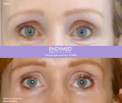 endymed-bleph skin tightening waterloo