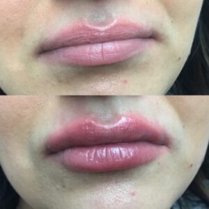 Fillers Before and After Results Waterloo