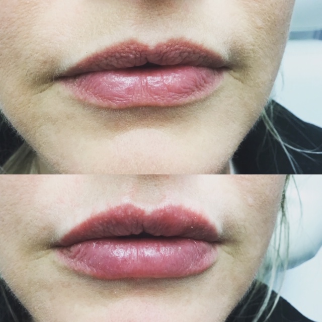 Fillers Before and After Results