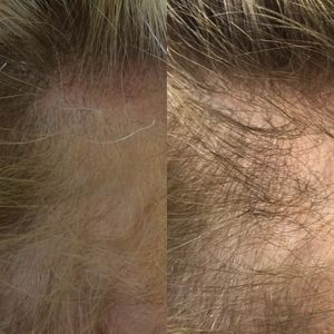 PRP Hair Restoration - Your Skin RN