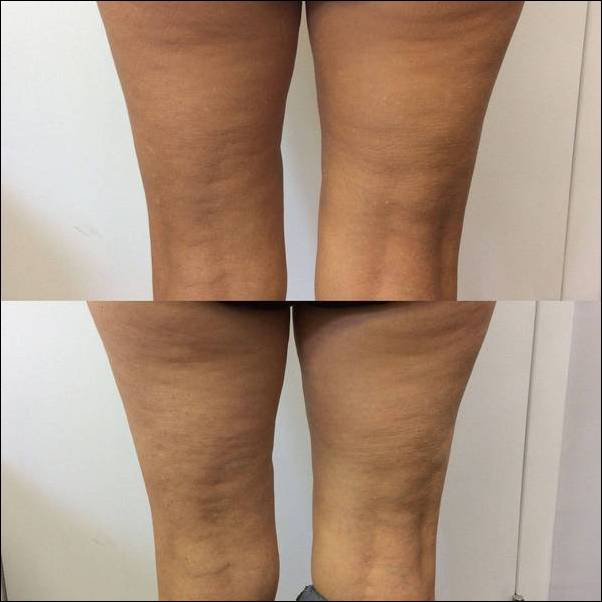 Skin Tightening Before and After
