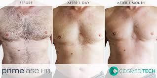 Chest-laser-hair-removal