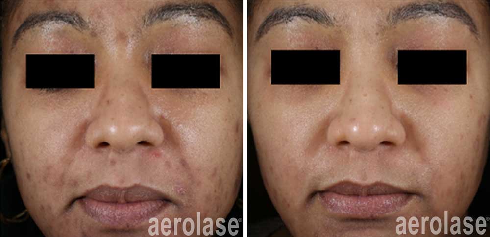 Aerolase - toxin, fillers, skin tightening and prp treatments