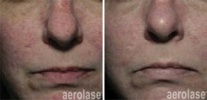 regain a youthful complexion with Aerolase skin tightening Waterloo