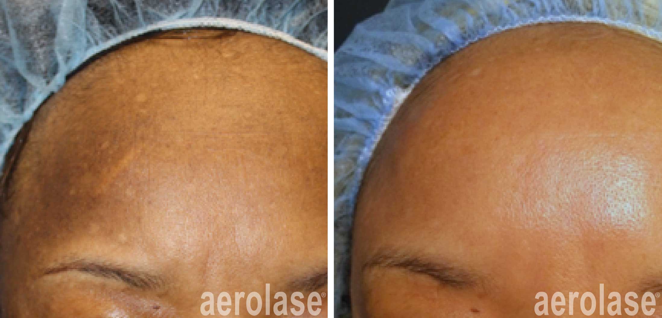 regain a youthful complexion with Aerolase