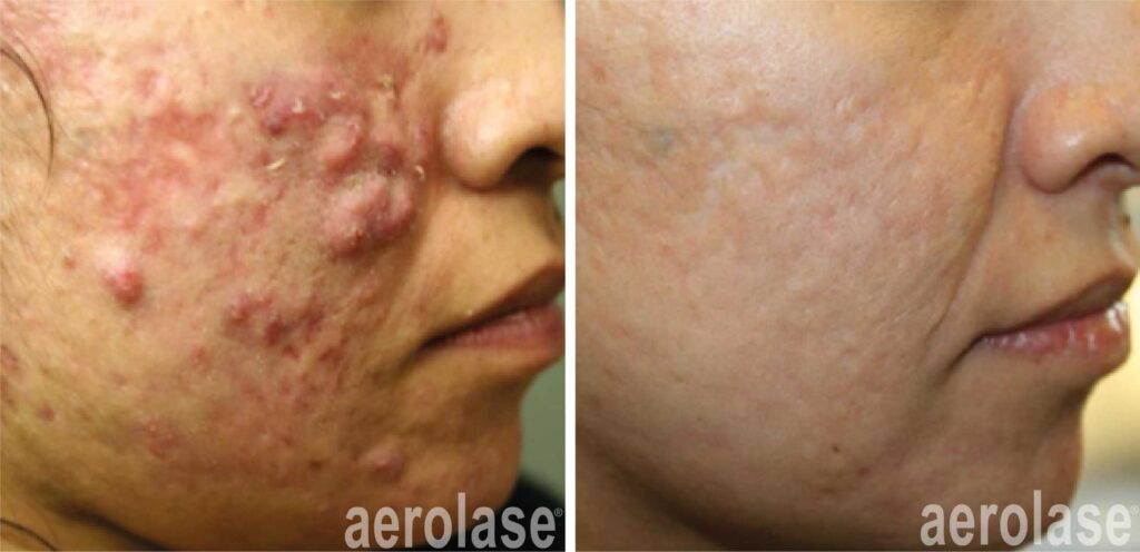 Aerolase - toxin, fillers, skin tightening and prp treatments