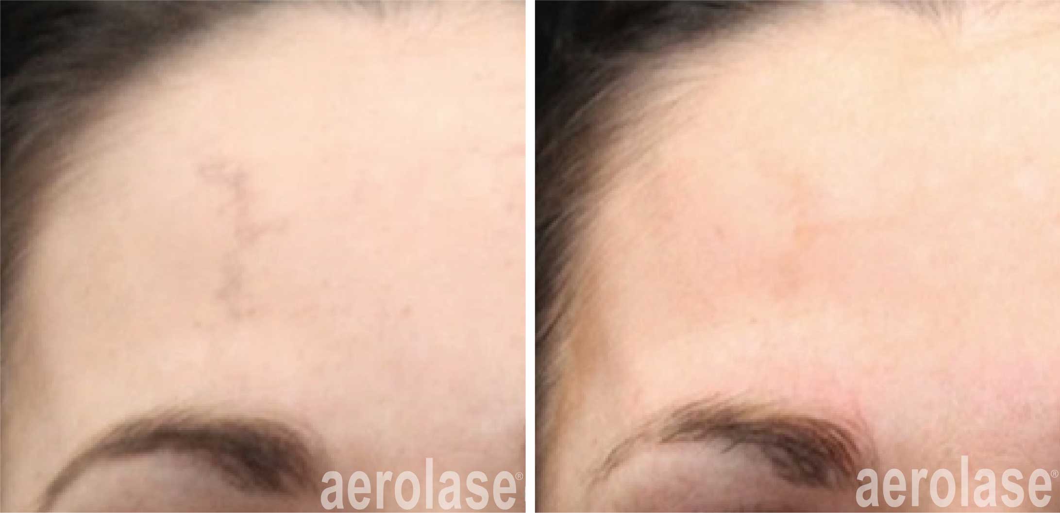 regain a youthful complexion with Aerolase